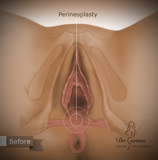 Perineoplasty1